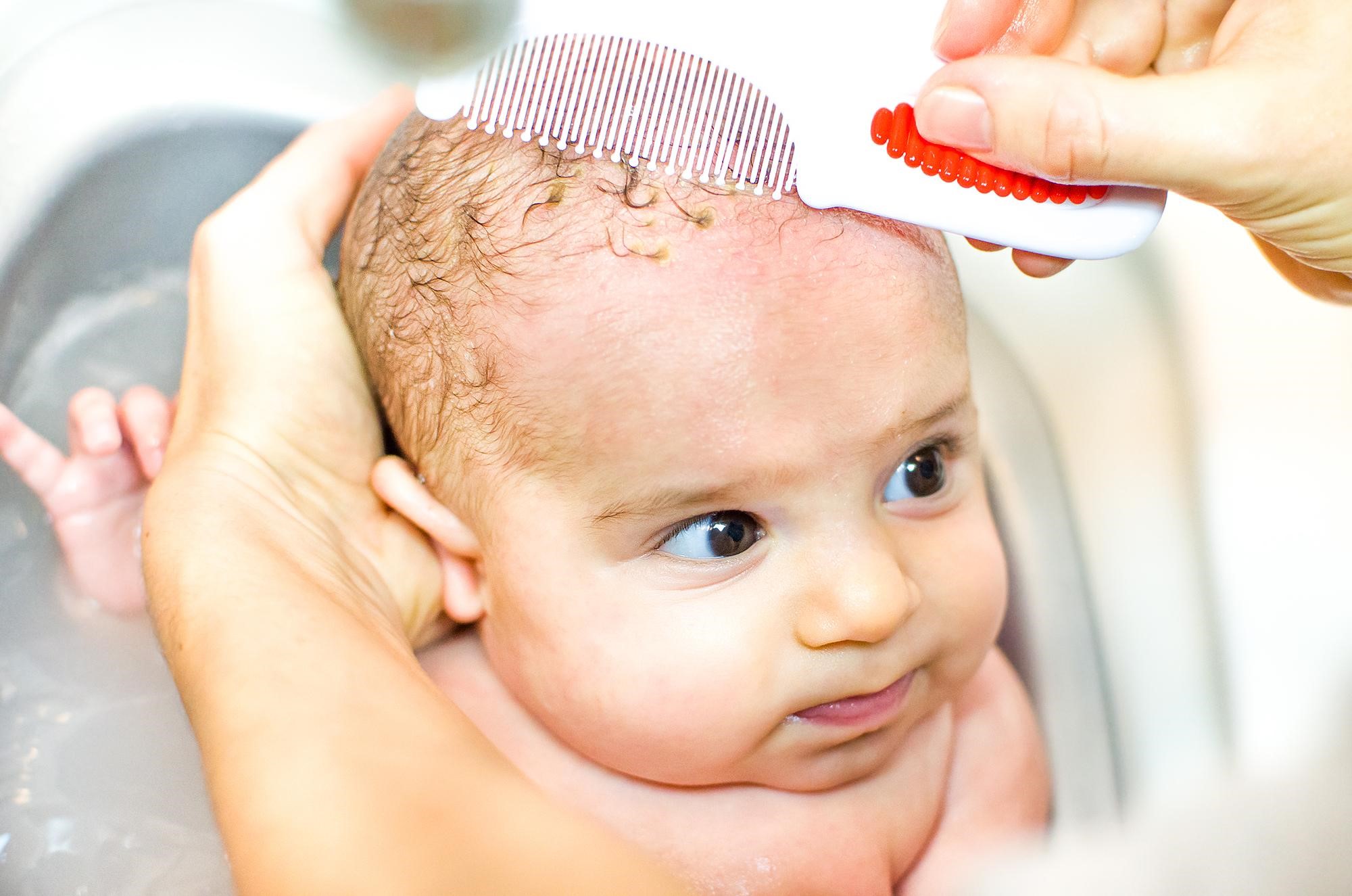 Себорейный дерматит волосистой части головы лечение у ребенка 5 лет thumbnail