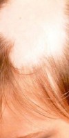 gnezdnaya alopeciya