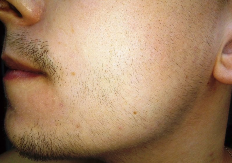 Все о миноксидиле для бороды: как пользоваться миноксидилом для бороды