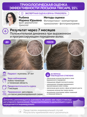 Лосьон для роста волос Трикапил 15% от выраженного и прогрессирующего выпадения волос Лосьон для роста волос Трикапил 15% от выраженного и прогрессирующего выпадения волос