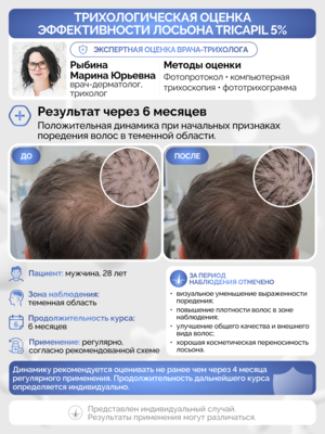 Лосьон для роста волос с тройным пептидным комплексом Трикапил 5% 2 Купить Лосьон для роста волос с тройным пептидным комплексом Трикапил 5% фото 2