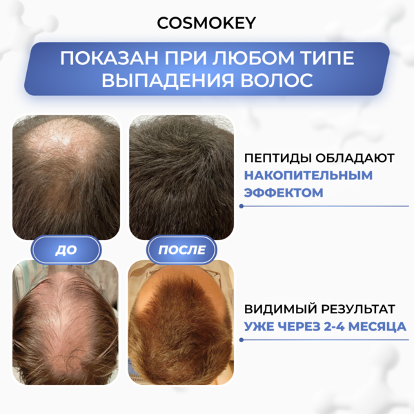 Купить Cosmokey Tricapil 5% Лосьон - активатор роста волос с тройным пептидным комплексом, 50 мл + мезороллер фото 1