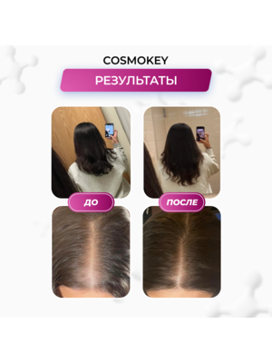 Cosmokey Tricapil 5% SOFT+ Лосьон - активатор роста волос для чувствительной кожи головы, 50 мл + мезороллер 2 Купить Cosmokey Tricapil 5% SOFT+ Лосьон - активатор роста волос для чувствительной кожи головы, 50 мл + мезороллер фото 2