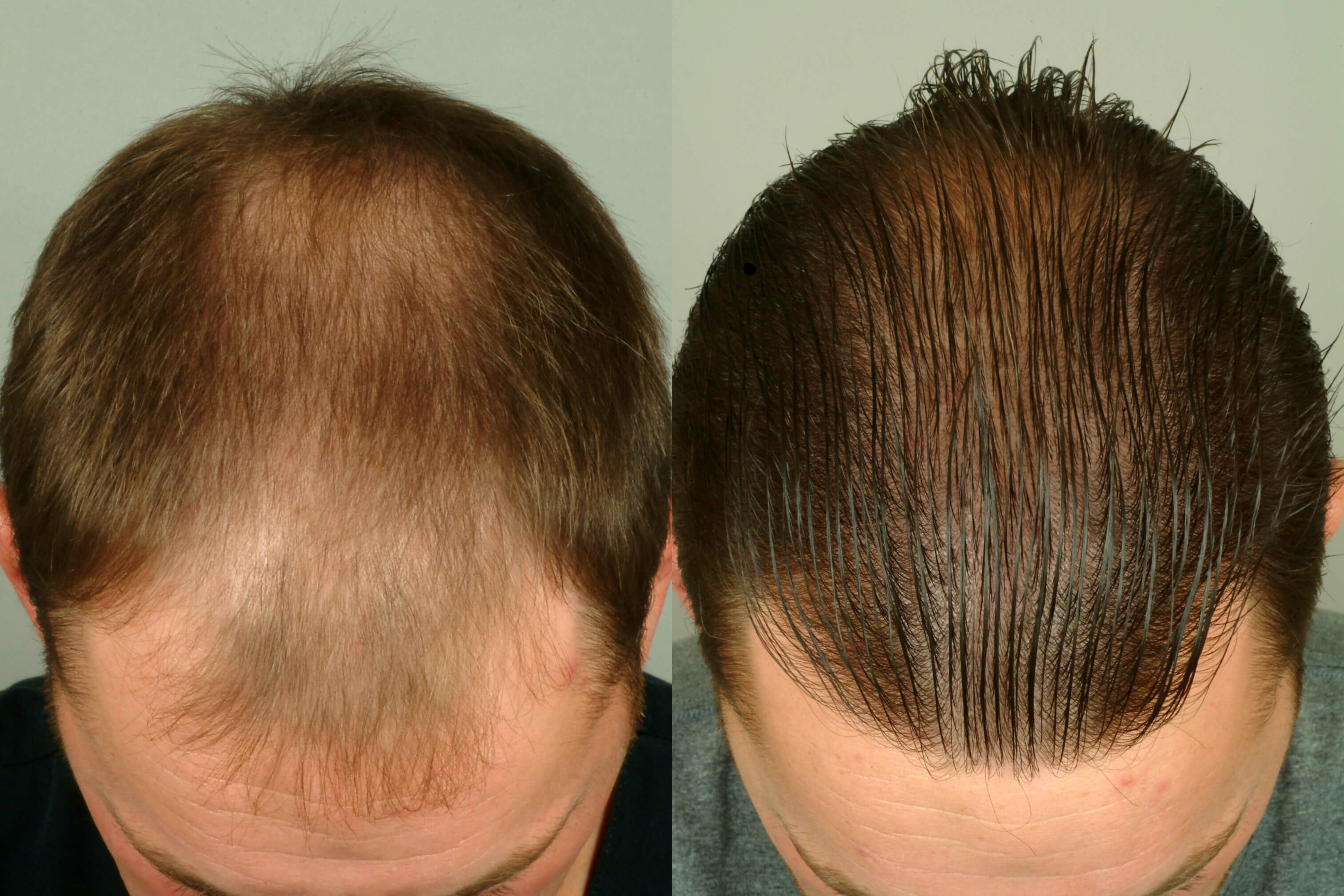 пересадка волос на голове до и после