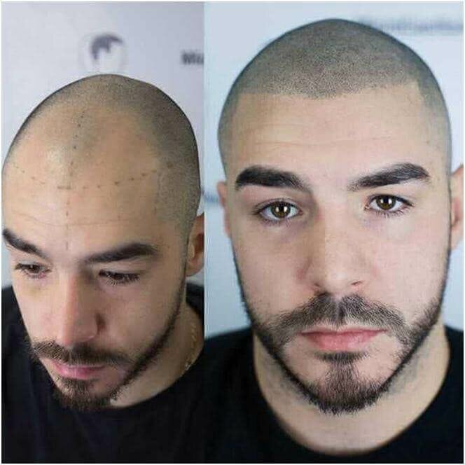 трихопигментация волос до и после фото 1