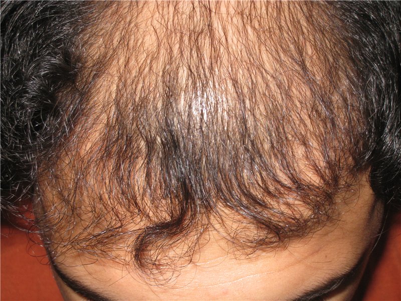 Выпадение волос при миноксидиле 2 thumbnail