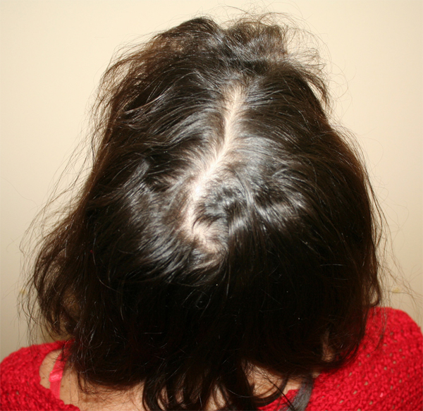 Миноксидил при выпадении волос для женщин