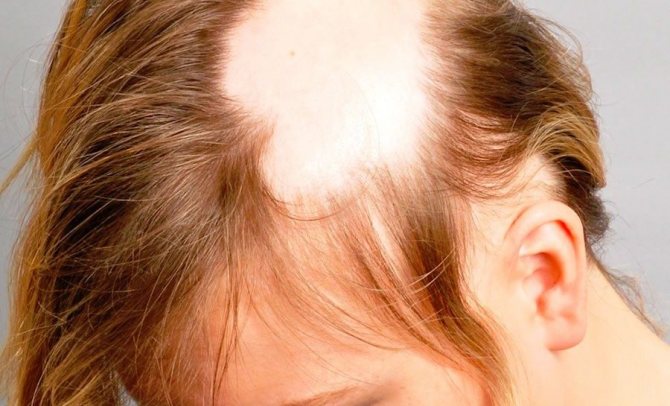 gnezdnaya alopeciya