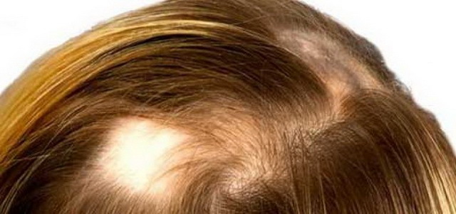 razvitie gnezdnoj alopecii