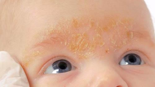 себорейный дерматит у детей на лице
